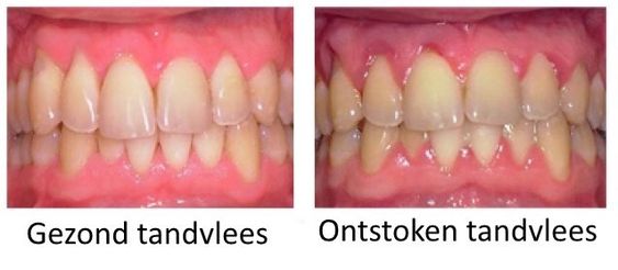 gezond tandvlees ontstoken tandvlees 